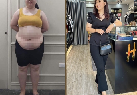 Tỷ lệ thành công của phẫu thuật nội soi thu nhỏ dạ dày như thế nào?